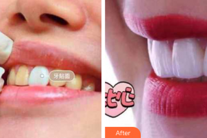 珠海拜博口腔醫(yī)院金晶整形價(jià)格表附瓷貼面案例展示