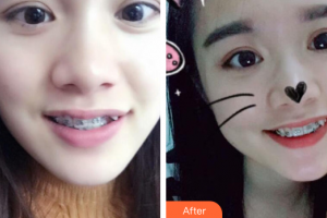 珠海拜博口腔醫(yī)院張立超整形價(jià)格表附金屬矯正案例展示