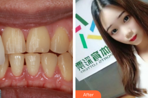 珠海優(yōu)里卡齒科門診部畢春英整形價(jià)格表附牙齒隱形矯正案例展示