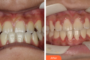 珠海建輝口腔診所鐘建輝整形價(jià)格表附自鎖矯正案例展示