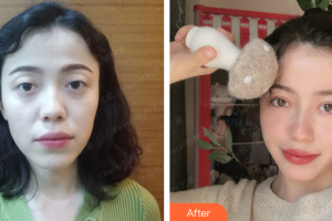 珠海雅媛醫(yī)療美容門診部張志欣整形價(jià)格表附眼部綜合案例展示