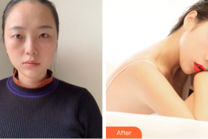 珠海雅媛醫(yī)療美容門診部張嘯整形價(jià)格表附眼部綜合案例展示