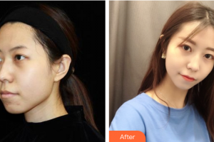 珠海藝星（原仁愛）醫(yī)療美容門診部梁勇整形價(jià)格表附光子嫩膚案例展示