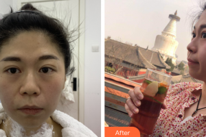 珠海藝星（原仁愛）醫(yī)療美容門診部羅家寧主診醫(yī)師整形價(jià)格表附熱瑪吉抗衰案例展示