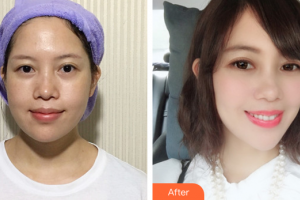 珠海美南華醫(yī)療美容醫(yī)院石顯文整形價(jià)格表附	超激光美膚祛斑案例展示