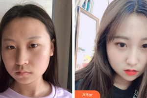 汕頭伊麗莎白整形美容醫(yī)院張紅軍整形價(jià)格表附埋線提升案例展示