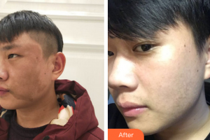 汕頭伊麗莎白整形美容醫(yī)院陳沛鳳整形價格表附激光祛斑案例展示