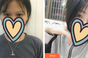 汕頭曙光整形美容醫(yī)院郭建濱整形價(jià)格表附眼部綜合案例展示