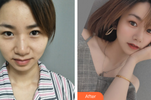 汕頭名流整形美容醫(yī)院李增貴整形價(jià)格表附眼部整形案例展示