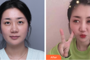 汕頭名流整形美容醫(yī)院李晶整形價(jià)格表附眼部整形案例展示