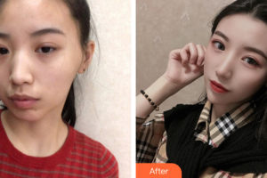 汕頭曙光整形美容醫(yī)院李炳輝整形價格表附顴骨顴弓案例展示