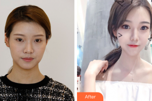 汕頭泛美泓涵醫(yī)療美容診所孫學(xué)梅整形價格表附多方面部埋線提升案例展示