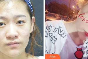 汕頭泛美泓涵醫(yī)療美容診所顧威整形價格表附切開雙眼皮案例展示