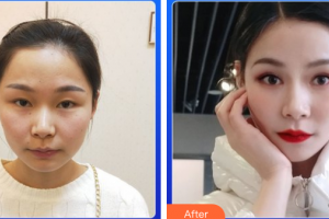 汕頭大學(xué)醫(yī)學(xué)院第一附屬醫(yī)院醫(yī)學(xué)美容中心鄭廷忠整形價格表附眼部整形案例展示