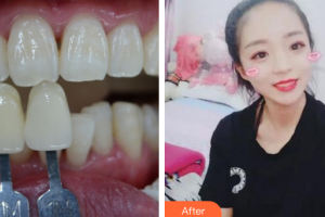 汕頭名流整形美容醫(yī)院鄒頌整形價格表附冷光美白案例展示