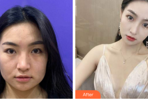 汕頭伊麗莎白整形美容醫(yī)院張雅琴整形價格表附抗衰老案例展示