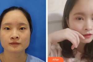 汕頭曙光整形美容醫(yī)院蔣翔峰整形價格表附切開雙眼皮案例展示