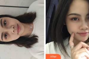 汕頭伊麗莎白整形美容醫(yī)院林璇娟整形價格表附激光去黑眼圈案例展示