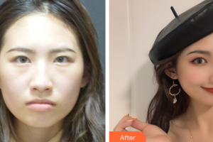 汕頭伊麗莎白整形美容醫(yī)院鄢莉萍整形價格表附鼻部綜合案例展示