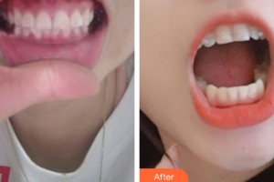 汕頭曙光整形美容醫(yī)院麻偉達(dá)整形價格表附國產(chǎn)直絲弓矯正案例展示