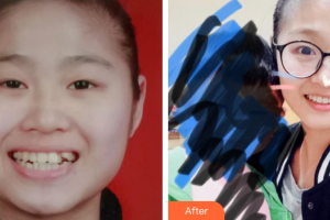 汕頭名流整形美容醫(yī)院麻維達(dá)整形價格表附金屬托槽案例展示