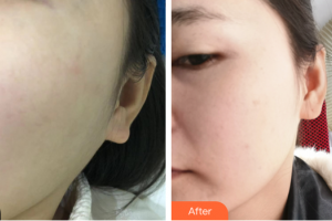 汕頭華美醫(yī)療美容醫(yī)院郭雨霏整形價格表附光子嫩膚案例展示