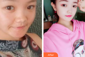 汕頭大學(xué)醫(yī)學(xué)院第一附屬醫(yī)院醫(yī)學(xué)美容中心李宇整形價格表附果酸煥膚案例展示