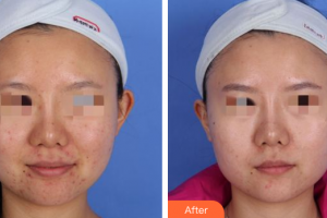 汕頭大學(xué)醫(yī)學(xué)院第一附屬醫(yī)院醫(yī)學(xué)美容中心李宏生整形價格表附皮膚管理案例展示