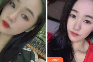 汕頭大學(xué)醫(yī)學(xué)院第一附屬醫(yī)院醫(yī)學(xué)美容中心許宏權(quán)整形價格表附光子嫩膚案例展示