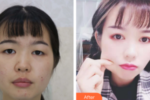 汕頭華美醫(yī)療美容醫(yī)院何斌整形價(jià)格表附切開(kāi)雙眼皮案例展示