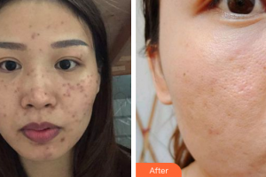 汕頭大學(xué)醫(yī)學(xué)院第二附屬醫(yī)院燒傷整形科唐世杰整形價(jià)格表附去痘印痘坑案例展示