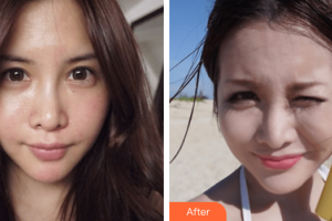 汕頭大學(xué)醫(yī)學(xué)院第二附屬醫(yī)院燒傷整形科李海紅整形價(jià)格表附祛斑案例展示