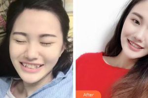 汕頭邱寧口腔診所吳裕娜整形價格表附金屬矯正案例展示