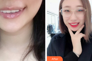 汕頭邱寧口腔診所陳曉發(fā)整形價(jià)格表附隱形矯正案例展示