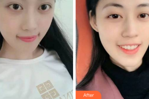 汕頭邱寧口腔診所邱寧整形價(jià)格表附瓷貼面案例展示