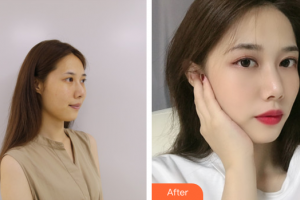 佛山曙光金子醫(yī)學(xué)美容醫(yī)院鄭永健整形價(jià)格表附玻尿酸精華導(dǎo)入案例展示