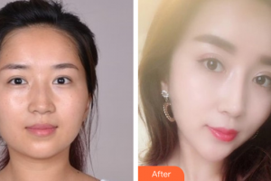 佛山曙光金子醫(yī)學(xué)美容醫(yī)院沈荷云整形價(jià)格表附美白嫩膚案例展示