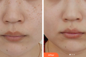 佛山曙光金子醫(yī)學(xué)美容醫(yī)院甘廣蓮整形價(jià)格表附激光祛除雀斑案例展示