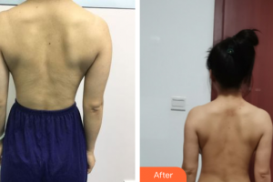 佛山東方女子醫(yī)院整形美容中心林淵慧整形價(jià)格表附手臂吸脂案例展示