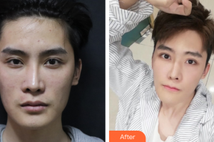 佛山瑞芙臣?jí)袈夺t(yī)學(xué)整形美容醫(yī)院陸小湖整形價(jià)格表附超激光美膚祛斑案例展示