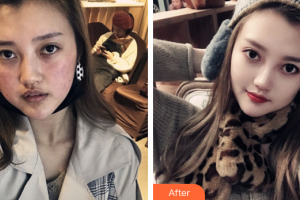 佛山蘇李秀英醫(yī)院激光整形科王晶整形價(jià)格表附果酸換膚案例展示