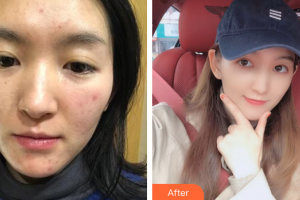 佛山市南海人民醫(yī)院燒傷整形科何冬誠(chéng)整形價(jià)格表附微針美膚案例展示