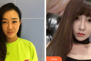 佛山市南海人民醫(yī)院燒傷整形科盧君整形價(jià)格表附無針?biāo)獍咐故?>
</a>
<h3 class=