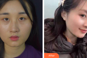 山東省千佛山醫(yī)院整形外科王彥整形價(jià)格表附切開雙眼皮案例展示