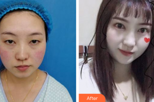 佛山廣美醫(yī)療美容門診部王文整形價(jià)格表附眼部手術(shù)案例展示