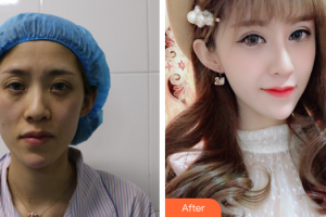 佛山瑞芙臣?jí)袈夺t(yī)學(xué)整形美容醫(yī)院林丹整形價(jià)格表附脂肪填充案例展示