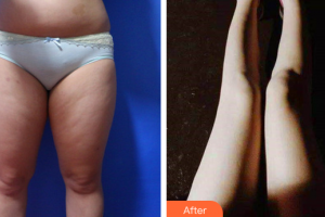 佛山蘇李秀英醫(yī)院激光整形科楊智偉整形價(jià)格表附大腿手臂吸脂案例展示