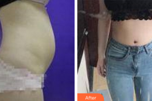 佛山瑞芙臣?jí)袈夺t(yī)學(xué)整形美容醫(yī)院王艷華整形價(jià)格表附腰腹吸脂案例展示