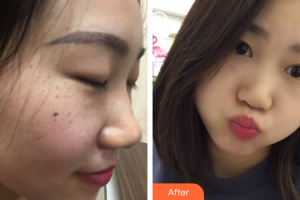 佛山蘇李秀英醫(yī)院激光整形科祝利敏整形價(jià)格表附祛雀斑案例展示