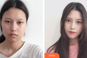 佛山市禪城中心醫(yī)院整形美容科楊偉杰整形價(jià)格表附下頜角整形案例展示